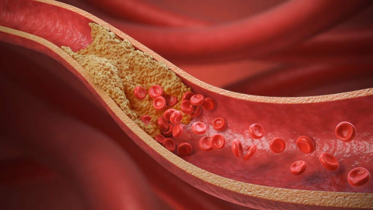 La propensión de la LDL a acumularse en las paredes arteriales lleva a la formación de una placa de aterosclerosis, como en la imagen (iStock).