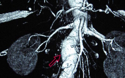 Identifican una nueva diana terapéutica para tratar el aneurisma de aorta abdominal