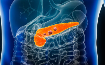 Identifican un nuevo factor que determina la agresividad del cáncer de páncreas