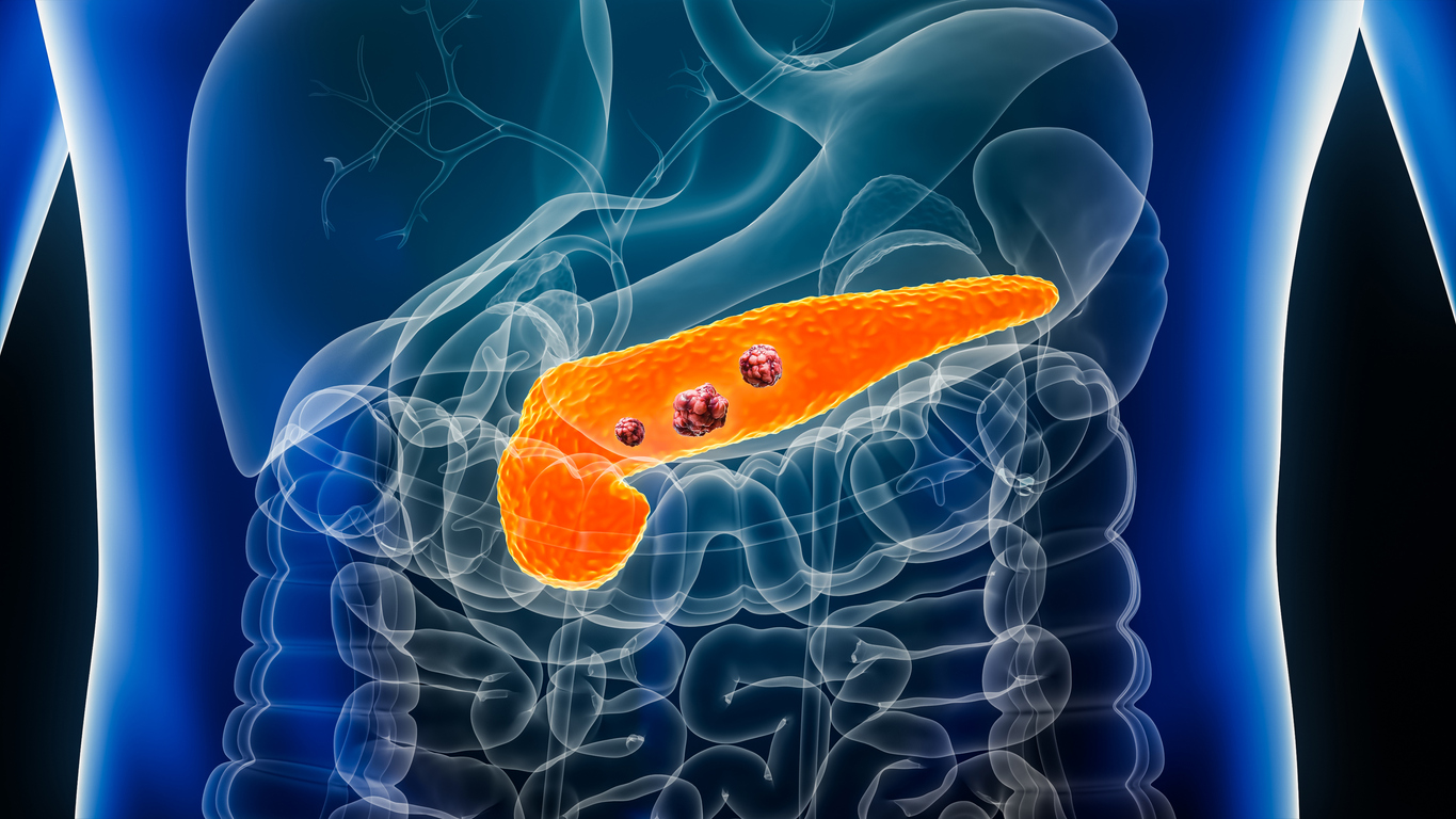 Las nuevas funciones descubiertas ahora abren la puerta a diseñar nuevas estrategias para atacar este tipo de tumor. / ISTOCK